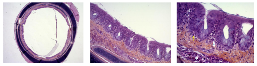 Score 1 = Light Inflammatory lesions. Spots of lymphocytes and Plasmocytes. Light congestion.