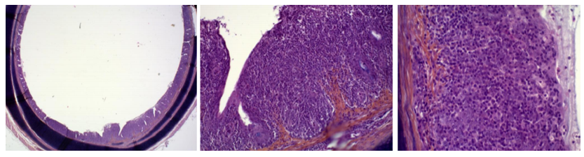 Score 3 =Severe Inflammatory lesions. Lymphocytes and plasmocytes invasion inducing thickening all around the trachea wall.