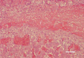Fig. 2. Serofibrinous perihepatitis consequent to E. coli septicaemia in a broiler chicken. Huge fibrinous pseudomembrane (f), coating the liver surface. H/E, Bar = 50 µm
