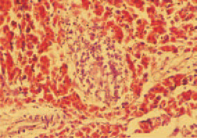 Fig. 10. Element of Fig. 9. Massive haemorrhages surrounding lymphatic clusters in the intestinal wall. H/E, Bar = 25 µm.