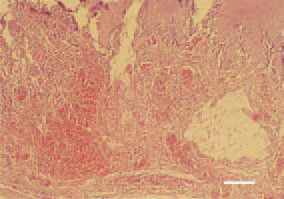 Fig. 12. Haemorrhages and cystic formations in the gizzard in colisepticaemia of enteric origin, secondary to necrotic enteritis. H/E, Bar = 40 µm.