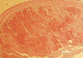 Fig. 13. Massive haemorrhages in the parenchyma of tonsila caecalis in colisepticaemia of enteric origin, secondary to necrotic enteritis. H/E, Bar = 50 µm.