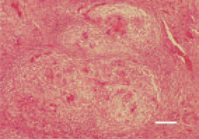 Fig 14. Coligranuloma (Hjarre’s disease). Conglomerates of granulomatous nodes against the intestinal wall. Central necrotic detritus and marked acidophilia. Single foreign body-type giant cells. H/E, Bar = 30 µm.