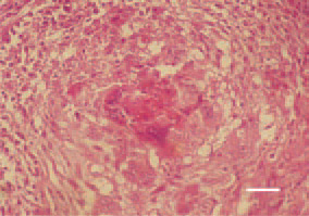 Fig. 16. Coligranuloma (Hjarre’s disease). Coligranuloma, liver. The typical heterophilic debris among the central necrotic detritus. H/E, Bar = 25 µm.