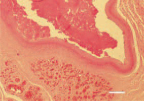 Fig. 17. Sternal bursitis. Filling of the sternal bursa with fibrinous caseous exudate. Peripheral outgrowth of fibrous tissue and inflammatory hyperaemia. H/E, Bar = 100 µm.