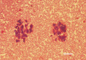 Fig. 4. Bacterial emboli obturating
capillary sinusoids and intensive degenerative
necrobiotic lesions of the
liver, resulting from metastasis of a
local focus of staphylococcal infection.
H/E, Bar = 35 µm.