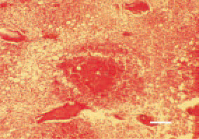 Fig. 5. Staphylococcal osteomyelitis,
secondary to septicaemia. An inflammatory
necrotic focus, bacterial colonization
and bone marrow congestion.
H/E, Bar = 30 µm.
