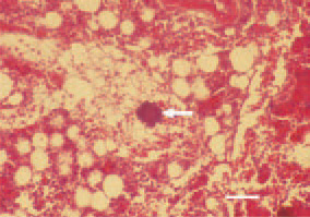 Fig. 6. Staphylococcal osteomyelitis.
Bacterial thrombus (arrow) obturating
a bone marrow sinusoid. H/E, Bar
= 25 µm.