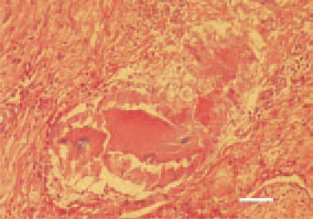 Fig. 8. Staphylococcal tenosynovitis.
Serofibrinous exudate filling the
synovial space, central necroses, with
clusters of bacterial colonies among
them. H/E, Bar = 25 µm.