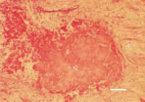 Fig. 11. Staphylococcal tenosynovitis.
Axial necrosis (N) of a tendon and
perifocal inflammatory oedema (e).
H/E, Bar = 30 µm.