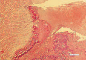 Fig. 2. Streptococcosis, duck. A mixed
wall thrombus (Tr) partially occluding
the left atrioventricular opening.
H/E, Bar = 50 µm.
