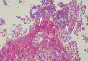 Fig. 3. Element of Fig. 2. Massive
clostridial colonization to the surface
of small intestinal mucosa (arrows).
H/E, Bar = 35 µm.