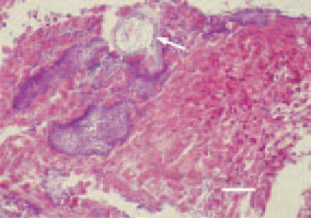 Fig. 4. Multiple clostridiae among the
necrotic intestinal mucosa and formation
of a cavity (arrow) as a result of
gas production. H/E, Bar = 25 µm.