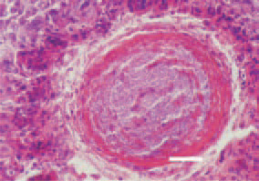 Fig. 4. Liver. Fibrosed and thickened
wall of a bile duct, filled with Grampositive
microorganisms after the
occurred inflammatory and necrotic
changes. H/E, Bar = 35 µm.