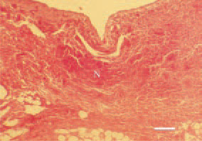 Fig. 1. Gangrenous dermatitis in a
broiler chicken. The microscopic lesions
are characterized with oedema,
emphysema, hyperaemia, haemorrhages
and necroses (N) in the subcutaneous
tissue. H/E, Bar = 100 µm.