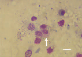 Fig. 2. Touch imprint preparation
from the air sac of a duck. Macrophageal
inflammatory cell response with
intracellular inclusions. Diff Quik, Bar
= 10 µm.