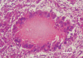 Fig. 2. Tubercle, liver, hen. Centrally,
a caseous necrosis of gathered epitheloid
cells, forming the basic mass of
the granuloma. Peripherally, foreign
body-type giant cells, arranged one
by the other in a wreath-like fashion.
H/E, Bar = 35 µm.