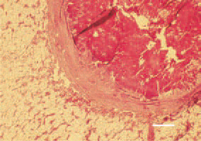 Fig. 3. Tubercle, bone marrow, ostrich.
Caseous necrosis and capsulation
of the granuloma. H/E, Bar = 25
µm.