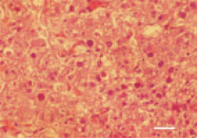 Fig. 1. Cross-section of the liver,
25-day-old broiler chicken. Multiple
basophilic intranuclear inclusion bodies
on the background of severe degenerative
necrobiotic parenchymal
lesions. H/E, Bar = 25 µm.