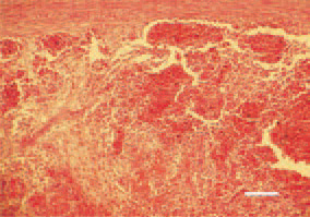 Fig. 4. In the spleen, hyperplasia of
the white pulp, necroses, subcapsular
and periarteriolar haemorrhages
could be generally observed, consequently
to a secondary E. coli septicaemia.
H/E, Bar = 100 µm.
