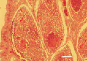 Fig. 3. Fragment of Fig. 2. Inflammatory
necrotic detritus among the B.
Fabricii follicles. H/E, Bar = 50 µm.