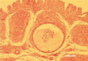Fig. 4. Sometimes, in the medullary
zone of follicles, cystic cavities could
be formed that contain exudate, imflammatory
cells and detritus mass.
H/E, Bar = 35 µm.