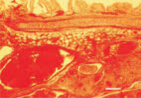 Fig. 4. Massive haemorrhages and
inflammation of nasal conchas in a
30-day-old broiler chicken. H/E, Bar
= 100 µm.