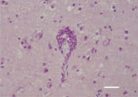 Fig. 1 & Fig. 2. Non-purulent encephalitis.
Perivascular microglial proliferation.
H/E, Bar = 30 µm.