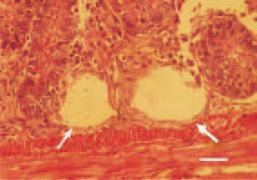 Fig. 2. Appearance of cystic crypts
(arrows) in duodenal mucosa. The
primary cause is possibly a retention
resulting from the compression of
the inflammatory proliferate in the
mucous coat. H/E, Bar = 35 µm.