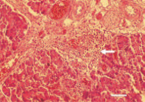 Fig. 3. Perivascular inflammatory cell
proliferate in the pancreas (arrow).
H/E, Bar = 50 µm.