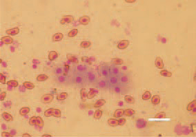 Fig. 3. Marek’s disease, pullet, touch
imprint preparation of a liver crosssection.
Lymphoid cells of a various
size: lymphoblasts and lymphocytes.
Diff Quik, Bar = 10 µm.