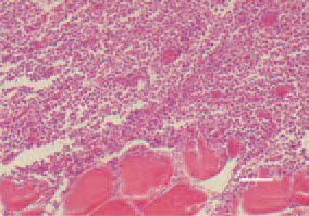 Fig. 4. Muscle tumour, Marek’s disease.
Focal pleomorphic cell proliferation.
H/E, Bar = 35 µm.