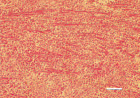 Fig. 5. Diffuse pleomorphic cell proliferation
in the myocardium, resulting
in atrophy of myofibrils. H/E, Bar =
35 µm.