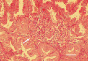 Fig. 8. Diffuse pleomorphic cell proliferation
in the proventriculus mucous
coat (arrow), hen. Compression and
atrophy of glandular acini. H/E, Bar
= 40 µm.