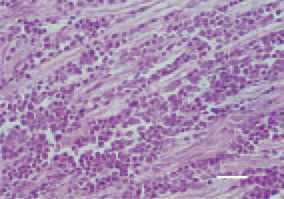 Fig. 9. Peripheral nerve. A-type lesion
(neoplastic type), marked lymphoid
cell proliferation, absence of oedema.
H/E, Bar = 25 µm.