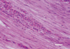 Fig. 11. Case of focal myelocytic proliferation
of the sciatic nerve, hen.
Bar = 25 µm.