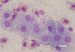Fig. 3. Equal-sized lymphoblast cells.
Touch imprint preparation, liver. Diff
Quik, Bar = 10 µm.