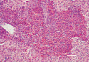 Fig. 1. Myelocytomatosis (MC) is characterized
by proliferation of immature
cells from the granulocyte order
– myelocytes and promyelocytes. It
has an aleukaemic character. Occurs
independently or in association with
a number of other neoplastic diseases.
Atypical morphological forms
are possible. Histologically, myelocytomas
are easily distinguinshed. Most
commonly, they have a perivascular
localization. Growth of myelocytes
with a relatively high degree of maturity
and well formed eosinophilic
granules in a liver cross-section. H/E,
Bar = 50 µm.