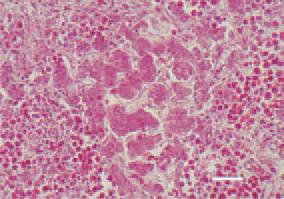 Fig. 2. Atrophic degenerative alterations
resulting from compression in a
case of intensive myelocyte proliferation
in the liver. H/E, Bar = 40 µm.