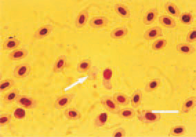 Fig. 6. Blood smear from a hen with
myelocytomatosis. A picture of anaemia
– anisocytosis, poikilocytosis,
erythrocyte without nucleus (arrow).
H/E, Bar = 10 µm.