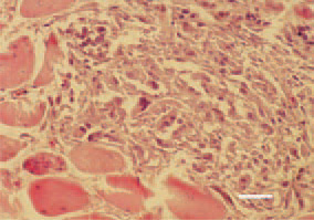 Fig. 7. Rhabdomyosarcoma, pectoral
muscle, hen. An extremely high
polymorphism of cells constituting
tumour parenchyma. H/E, Bar = 25
µm.