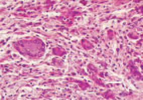 Fig. 8. Rhabdomyosarcoma located
in the thigh muscle of a hen. An area
with multiple hyperchromatic, polynuclear
cells. H/E, Bar = 25 µm.