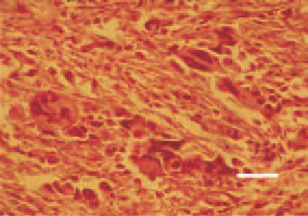Fig. 9. Leiomyosarcoma, mesosalpinx.
Polygonal giant cells with hyperchromatic
nuclei. H/E, Bar = 25 µm.