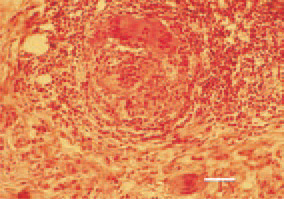 Fig. 10. Leiomyosarcoma, small intestine.
Prolongations of polynuclear
symplastic elements (arrows). H/E,
Bar = 30 µm