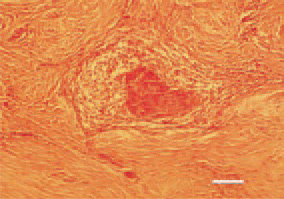 Fig. 14. Fibro-myxosarcoma, metastatic
focus in the cervical subcutis
from a primary mixed mesenchymal
tumour in the alimentary tract. H/E,
Bar = 40 µm.
