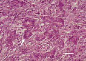 Fig. 15. Carcinosarcoma, pancreas.
Tubulous glandular epithelial formations
- carcinomatous component
(arrow), among the liposarcomatous
part of the parenchyma. H/E, Bar =
30 µm.