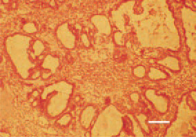 Fig. 20. Kidney, cystadenocarcinoma.
H/E, Bar = 35 µm.
