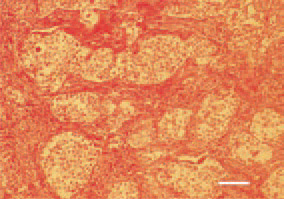 Fig. 21. Ovary, granulosa-theca cell
tumour. Islets of anaplastic cells, delineated
by well-developed stroma
of fibrous and smooth muscle fibres.
H/E, Bar = 30 µm.