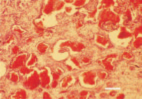 Fig. 23. Haemangiosarcoma of the
small intestinal wall. The parenchyma
consists of anastomizing canals with
papilliferous depressions. H/E, Bar =
50 µm.