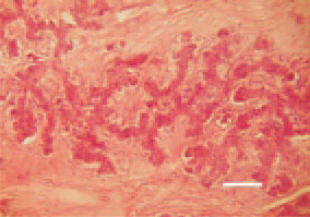 Fig. 26. Intrahepatic cholangiocarcinoma.
Irregular glandular papilliferous
neoplastic formations. Marked
stromal desmoplasia. Fibrous tissue
surrounding the neoplastic glands.
H/E, Bar = 50 µm.